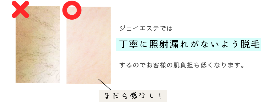 ジェイエステでは丁寧に照射漏れがないよう脱毛するのでお客様の肌負担も低くなります。