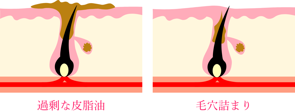 過剰な皮脂油 毛穴詰まり　イメージ